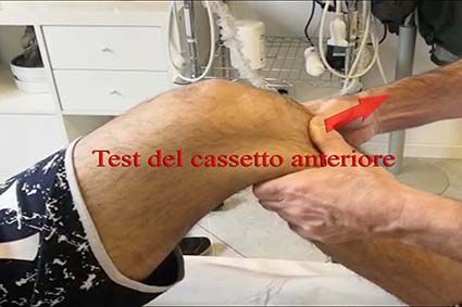 	Anterior Drawer Test (Test Cassetto Anteriore)